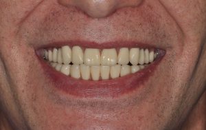 After Dentures