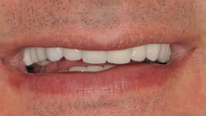 After Dental Crown