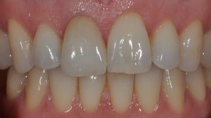 After Dental Crown