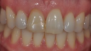 Before Dental Crown