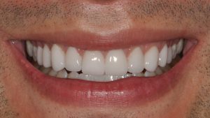 After Veneers