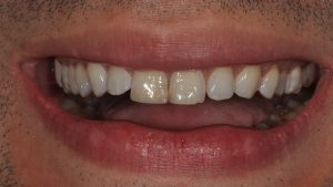 Before Veneers