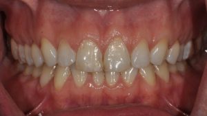 Before Veneers