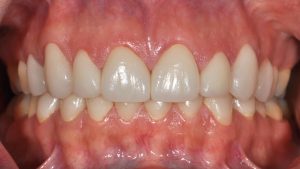 After Veneers