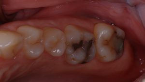 Before Tooth Filling