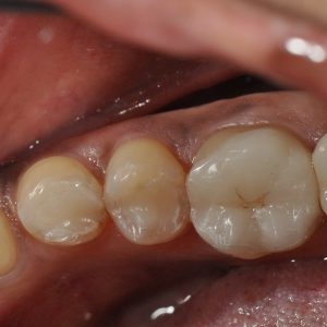 New White Tooth Fillings After Replacement