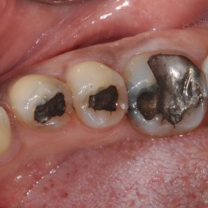Before Replacing Old Tooth Fillings