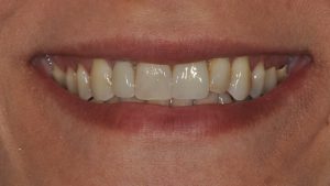 After Single Dental Implant