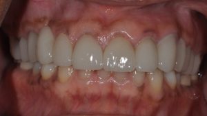  After Dental Crown case study photo