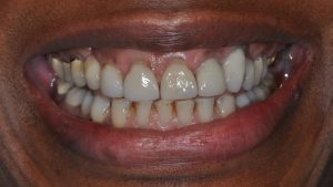 Before Dental Crown case study photo