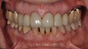 Before Dental Crown
