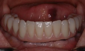 After Implants