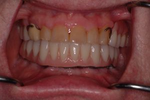 After Implants