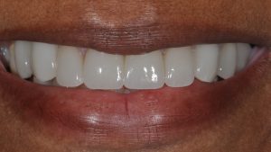 After Implants