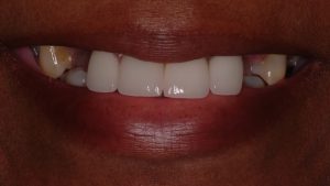 Before Dental Implants