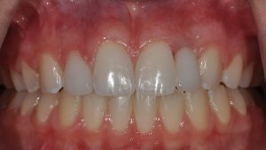 After Teeth Veneers, dental patient photo