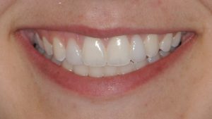 After Teeth Veneers case study photo