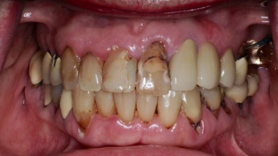 Caries/Decay before