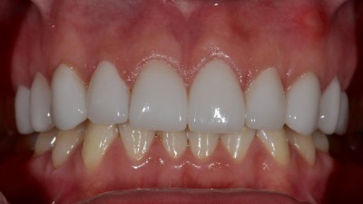Changing the size and shape of teeth after