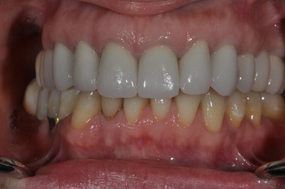 Conventional Crowns