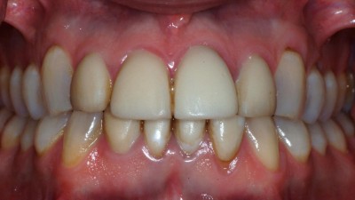 Discolored Teeth before