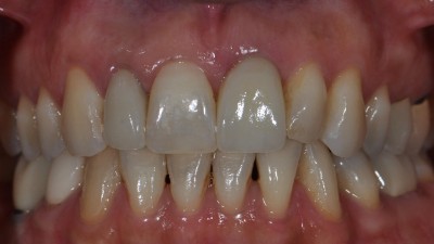 Failing Crowns/Restorations after
