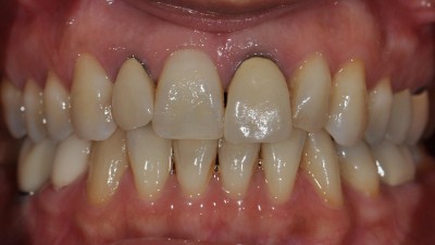 Failing Crowns/Restorations before