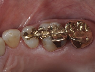 Gold Tooth Fillings