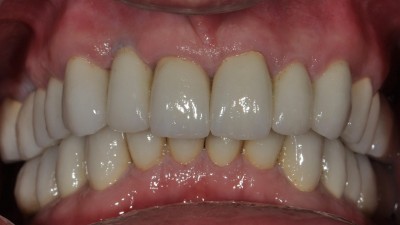 Large Cavities on the Anterior Teeth after