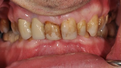 Large Cavities on the Anterior Teeth before