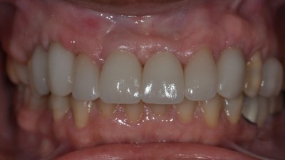 Previously Extracted Tooth Site after