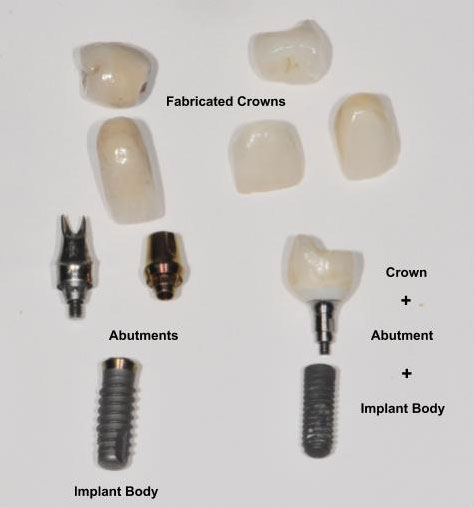 Parts of dental implants including fabricated crowns, abutment and dental implant body