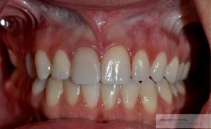 This patient suffered a dental injury while playing lacrosse but delayed seeking treatment. The resulting nerve damage darkened the color of the affected tooth.