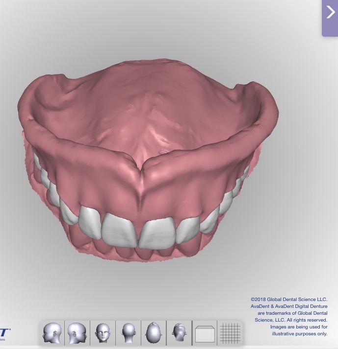 CAD designed Dentures