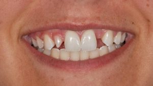 dental implants Obeid Dental