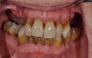 dental implants Obeid Dental